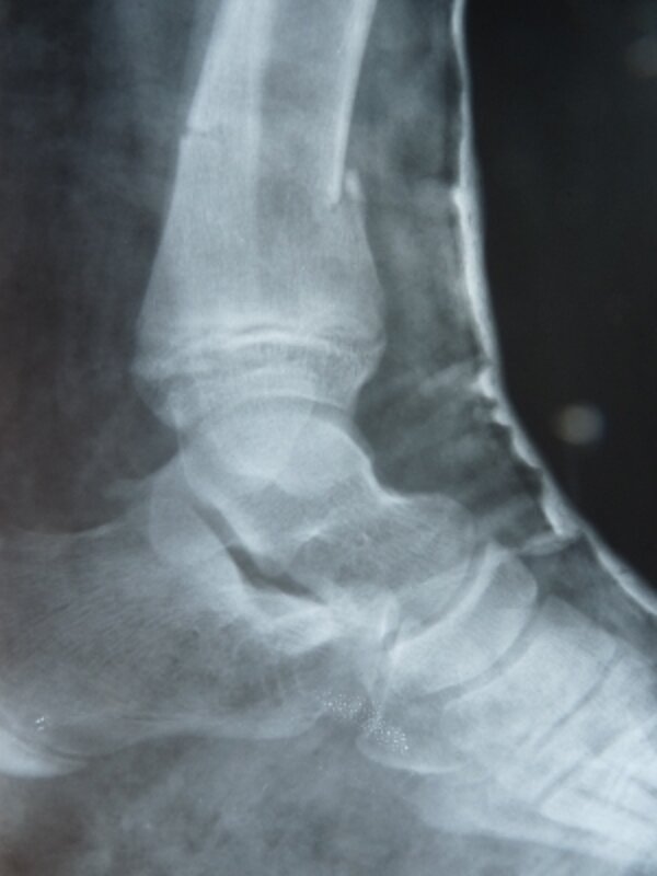 Röntgenbild eines Skiunfalls des Fußes